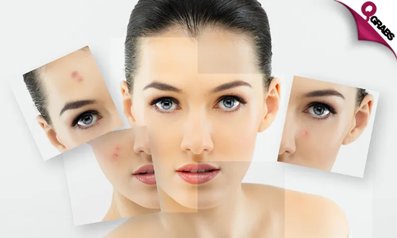 Derma Treatments!